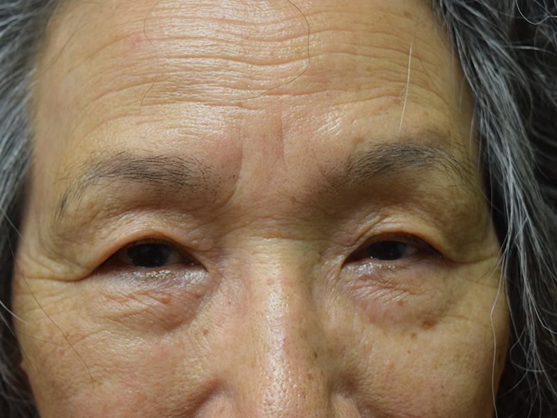 Eyelid Surgery Before and After | Dr. Nadeau - Plastic and Reconstructive Surgeon