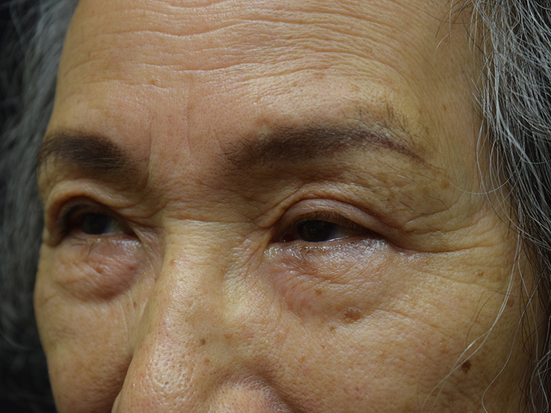 Eyelid Surgery Before and After | Dr. Nadeau - Plastic and Reconstructive Surgeon