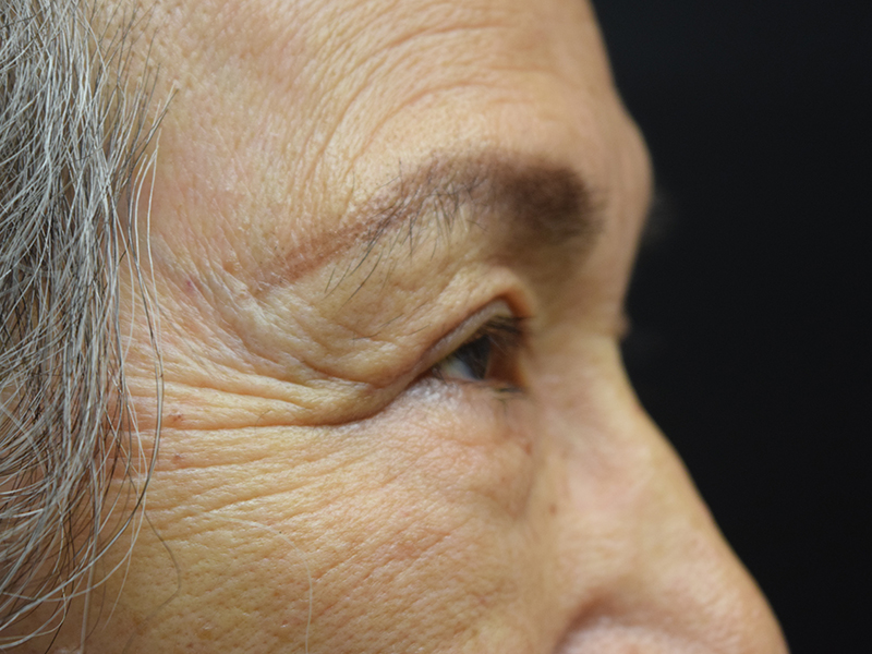 Eyelid Surgery Before and After | Dr. Nadeau - Plastic and Reconstructive Surgeon