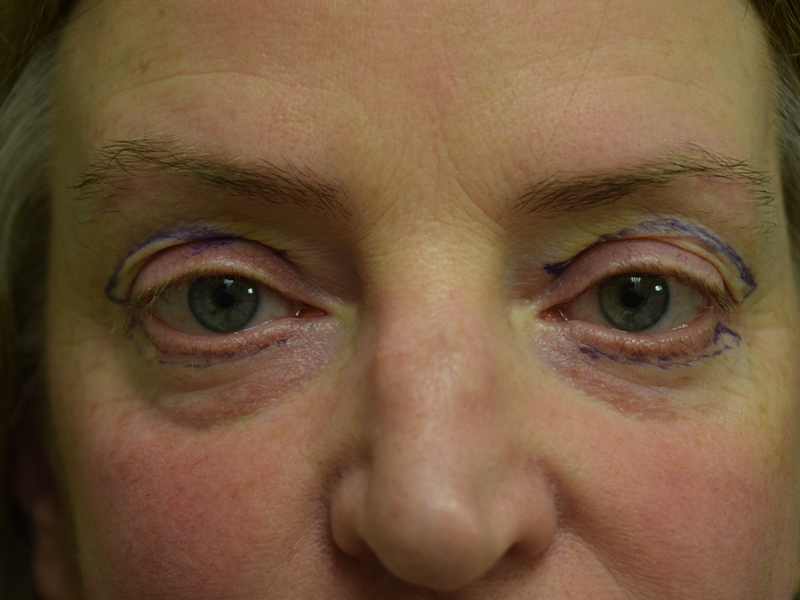 Eyelid Surgery Before and After | Dr. Nadeau - Plastic and Reconstructive Surgeon