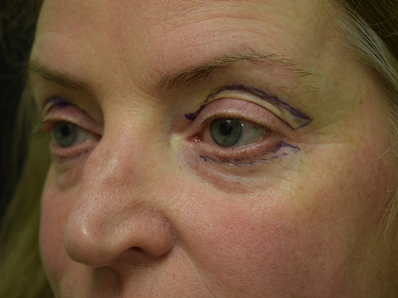 Eyelid Surgery Before and After | Dr. Nadeau - Plastic and Reconstructive Surgeon