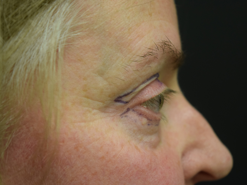 Eyelid Surgery Before and After | Dr. Nadeau - Plastic and Reconstructive Surgeon