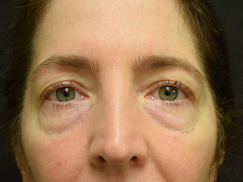 Eyelid Surgery Before and After | Dr. Nadeau - Plastic and Reconstructive Surgeon