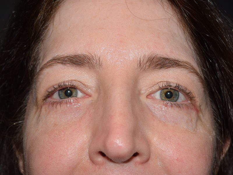 Eyelid Surgery Before and After | Dr. Nadeau - Plastic and Reconstructive Surgeon