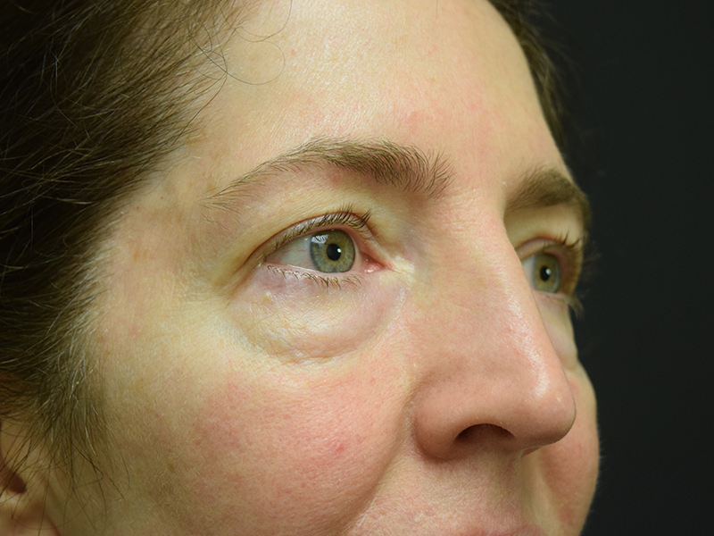 Eyelid Surgery Before and After | Dr. Nadeau - Plastic and Reconstructive Surgeon