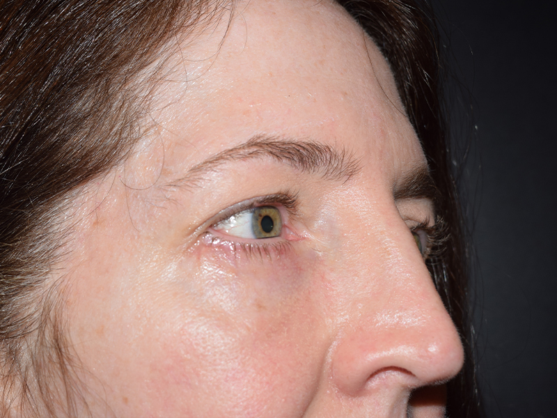 Eyelid Surgery Before and After | Dr. Nadeau - Plastic and Reconstructive Surgeon