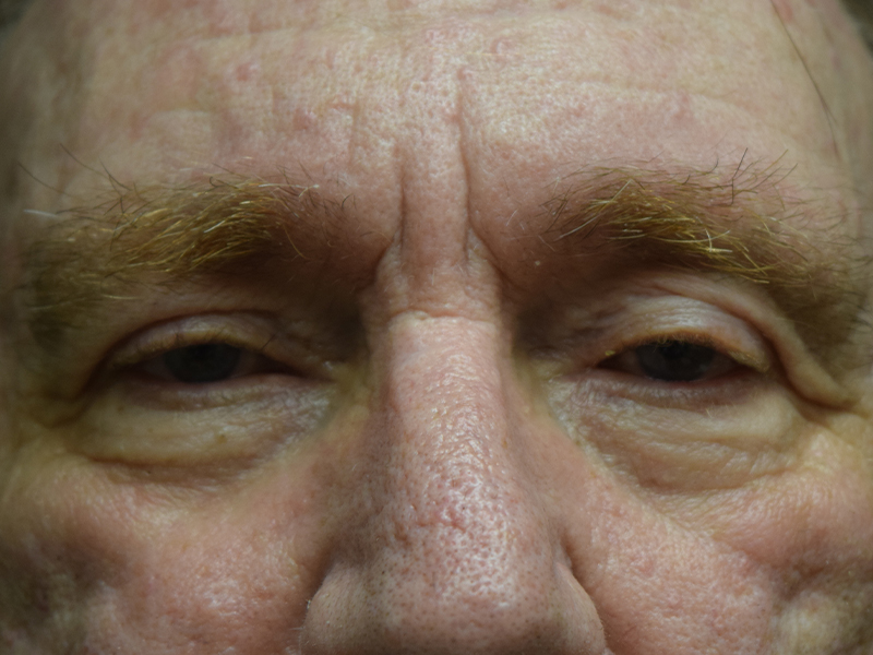 Ptosis Repair Before and After | Dr. Nadeau - Plastic and Reconstructive Surgeon