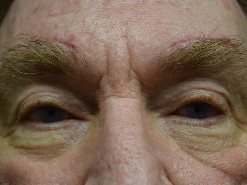 Ptosis Repair Before and After | Dr. Nadeau - Plastic and Reconstructive Surgeon