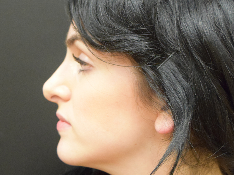 Rhinoplasty Before and After | Dr. Nadeau - Plastic and Reconstructive Surgeon