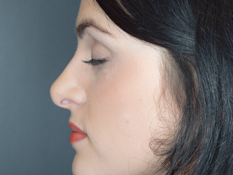 Rhinoplasty Before and After | Dr. Nadeau - Plastic and Reconstructive Surgeon