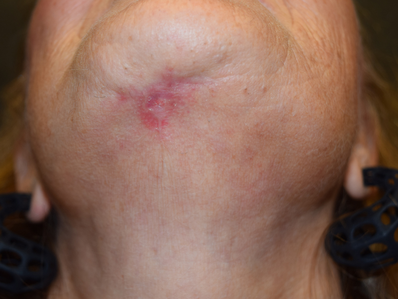 Scar Reduction Before and After | Dr. Nadeau - Plastic and Reconstructive Surgeon