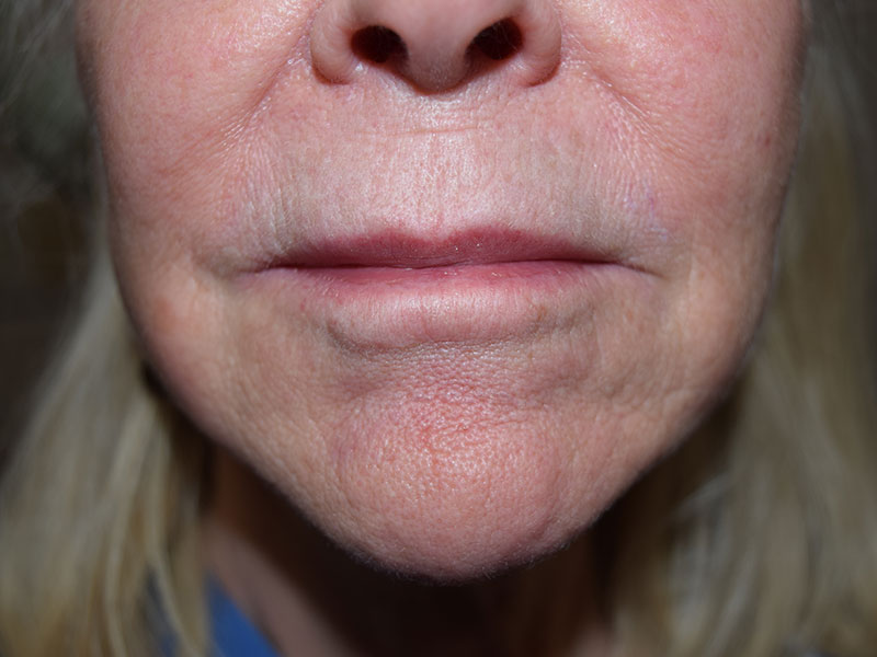 Dermal Fillers Before and After | Dr. Nadeau - Plastic and Reconstructive Surgeon