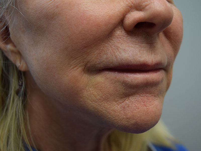 Dermal Fillers Before and After | Dr. Nadeau - Plastic and Reconstructive Surgeon