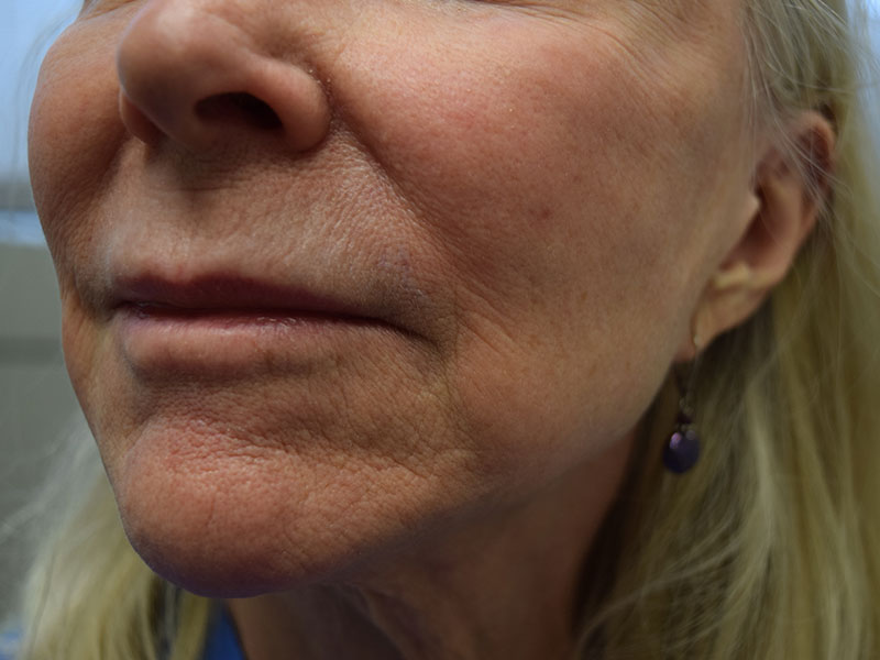 Dermal Fillers Before and After | Dr. Nadeau - Plastic and Reconstructive Surgeon
